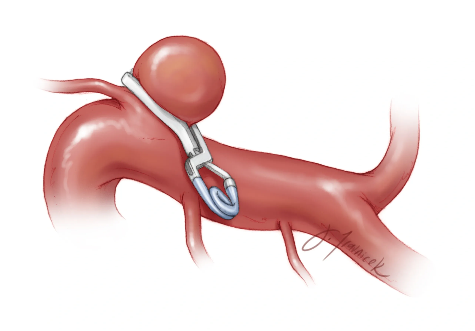 Aneurysm clipping procedure illustration