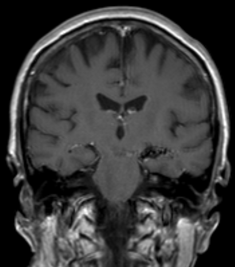 T1-weighted contrast-enhanced MRI in the coronal plane, showing an AVM