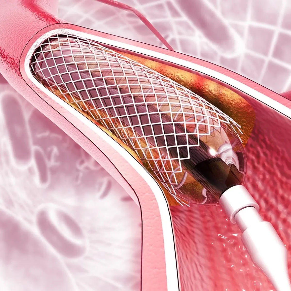Minimally invasive stenting procedure illustration