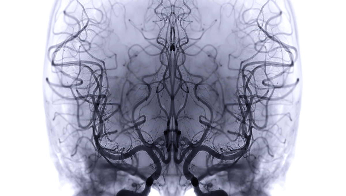 3D reconstruction of cerebral vasculature from cerebral angiography