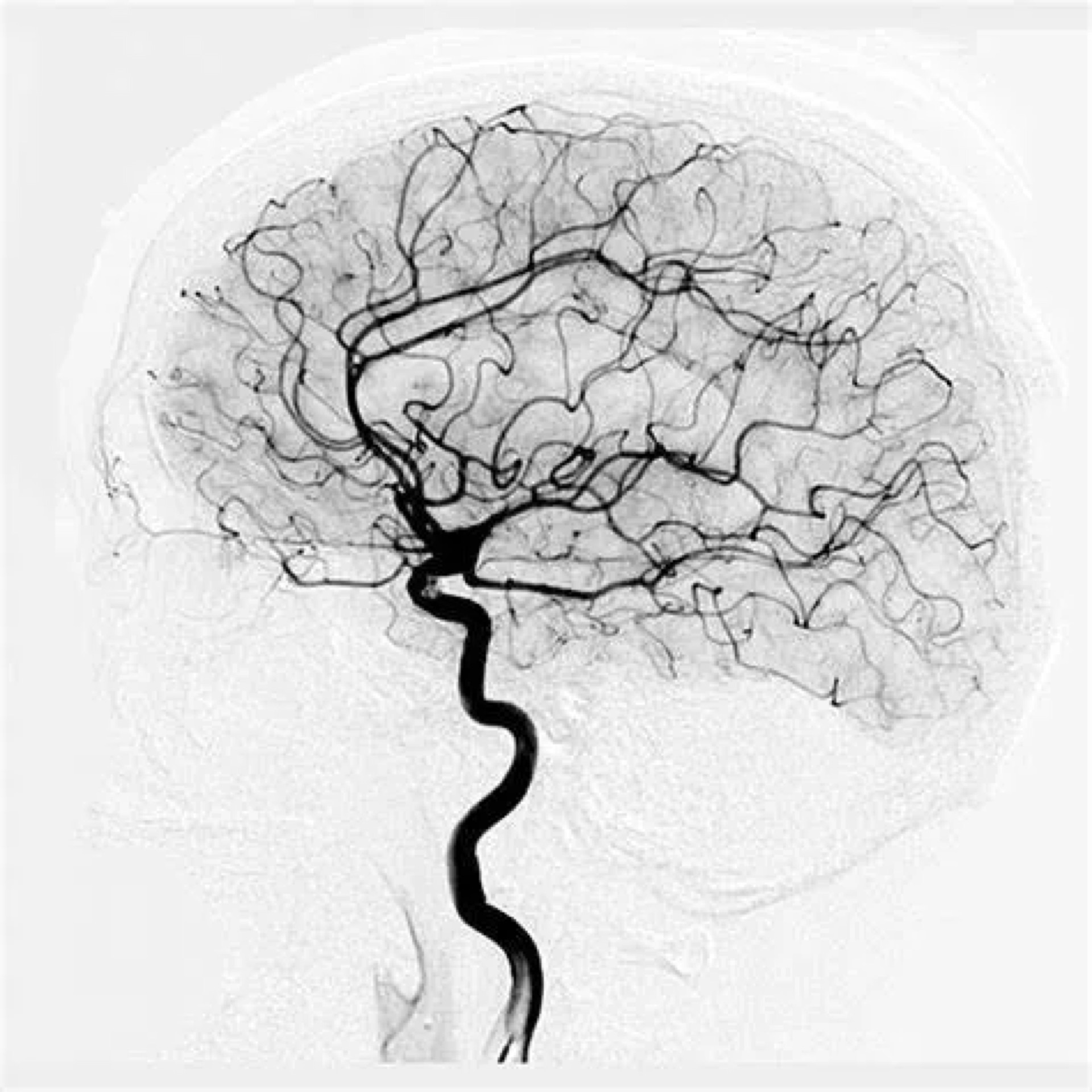 Conditions diagnosed by cerebral angiography