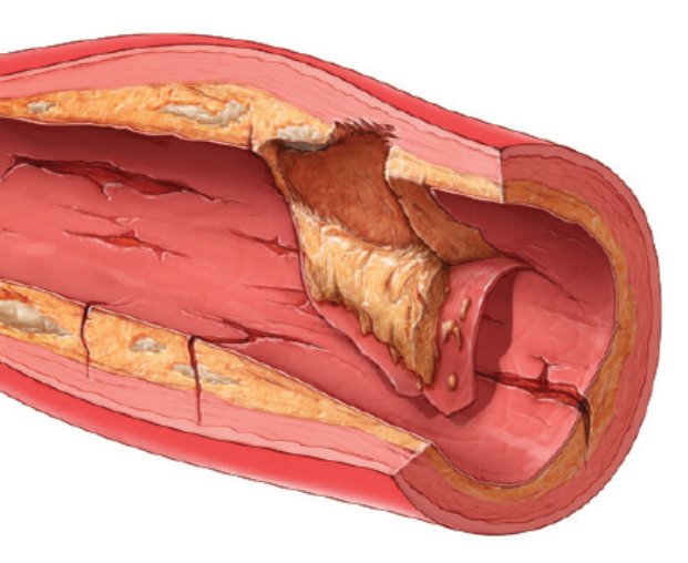 Treatment approach for arterial dissection