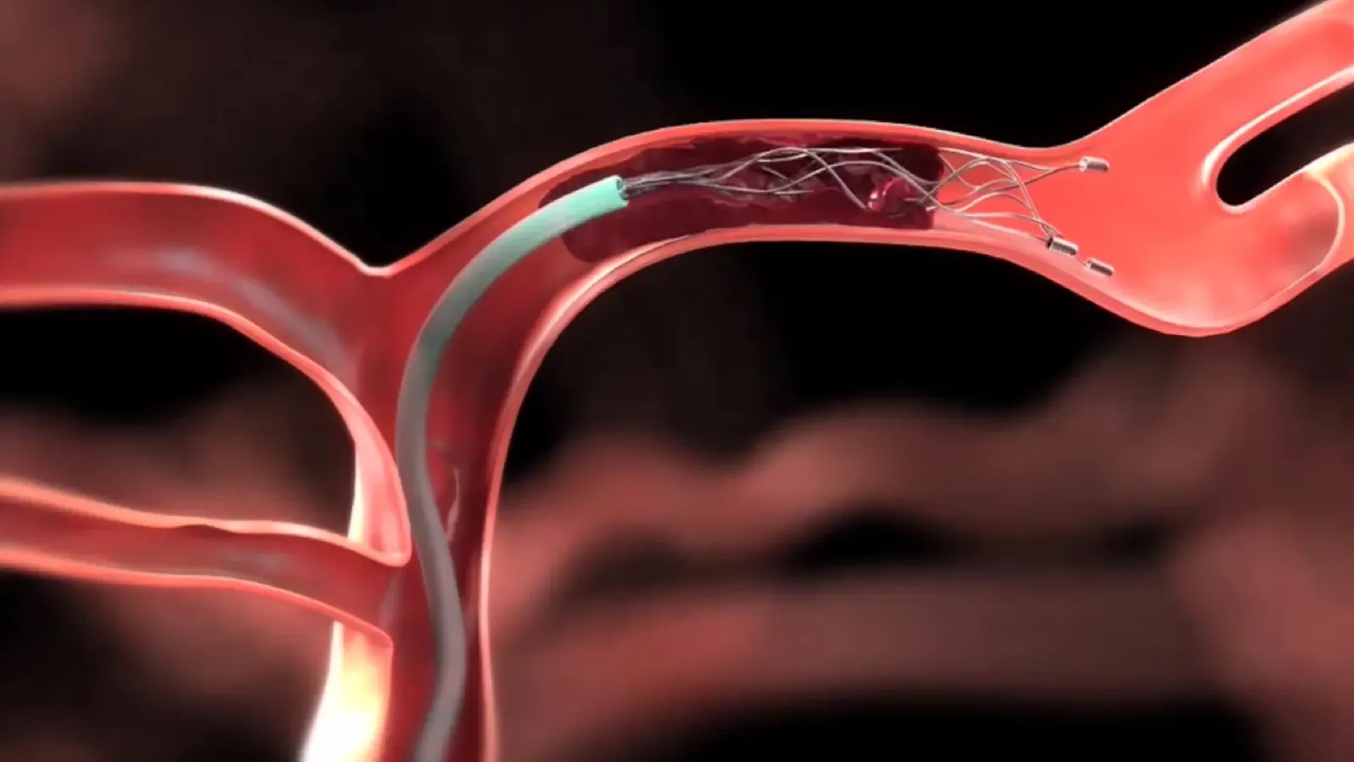 Time is brain — urgency of stroke treatment