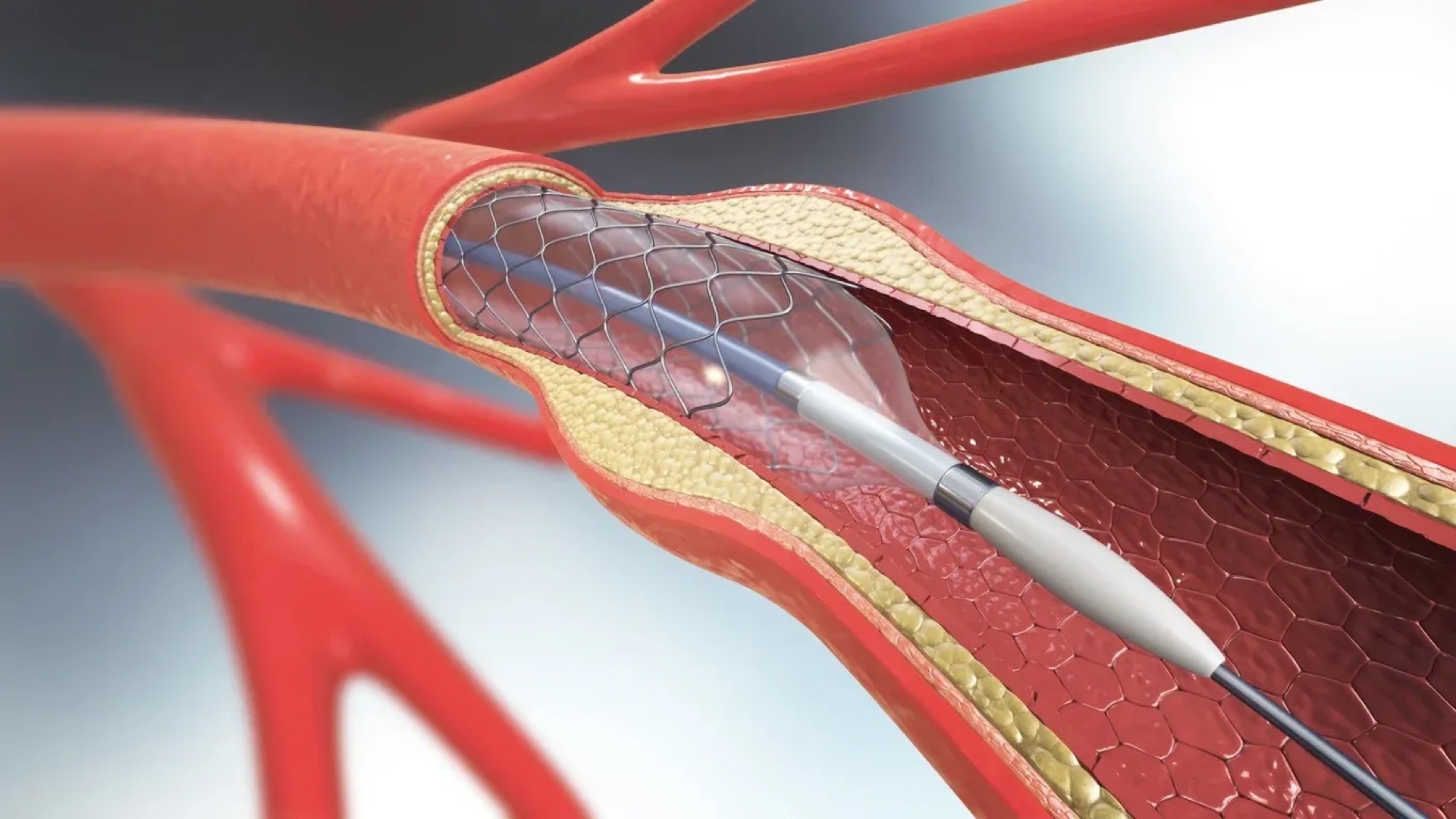Carotid artery stenting procedure illustration