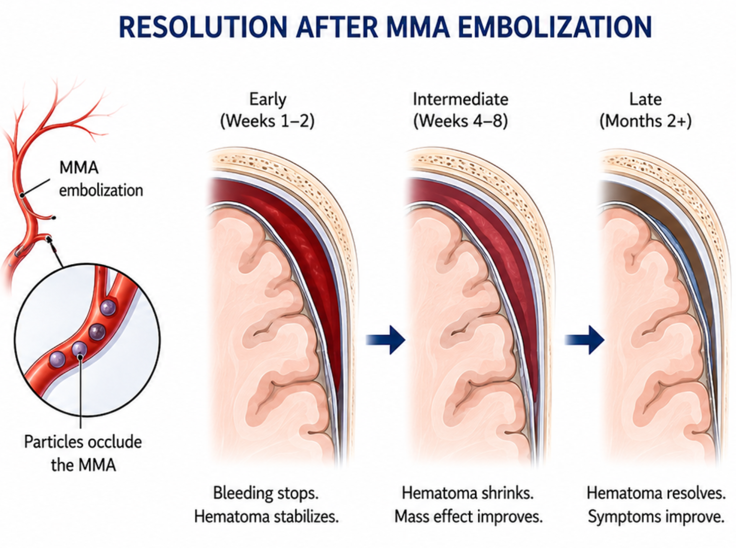 Benefits of embolization