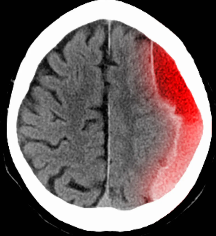 CT scan showing a subdural hematoma — emergency warning signs